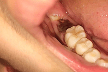 拔牙后第二天恢复图