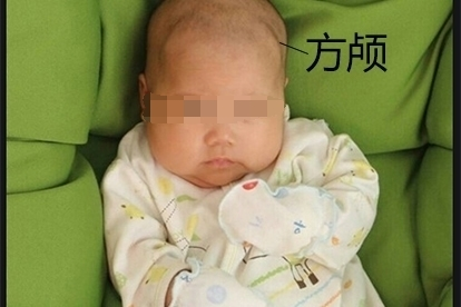 婴儿佝偻病睡姿图