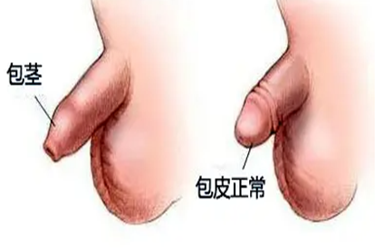 包茎对比