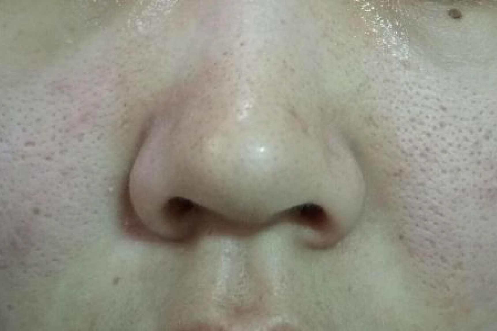 毛孔粗大是什么样