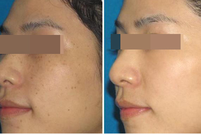 光子祛斑变化图片