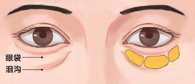 脸上泪沟