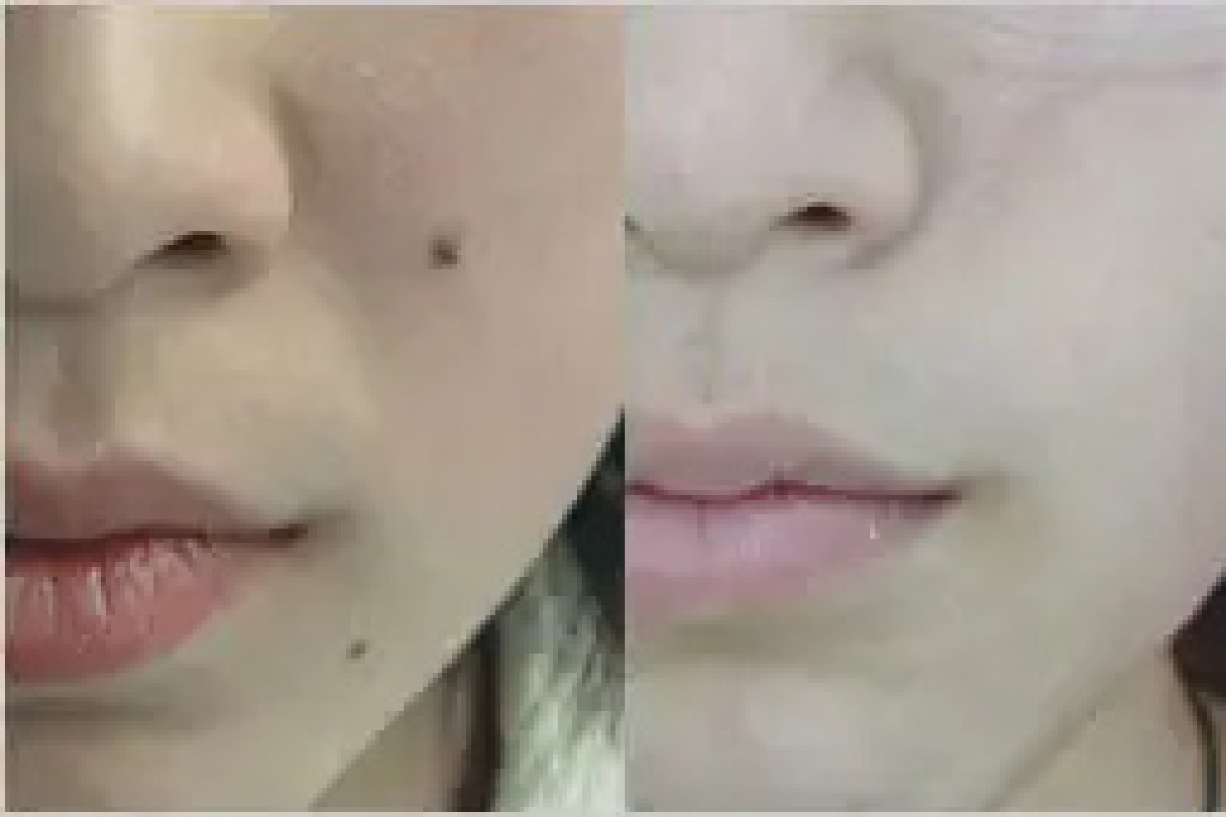 激光点痣效果图