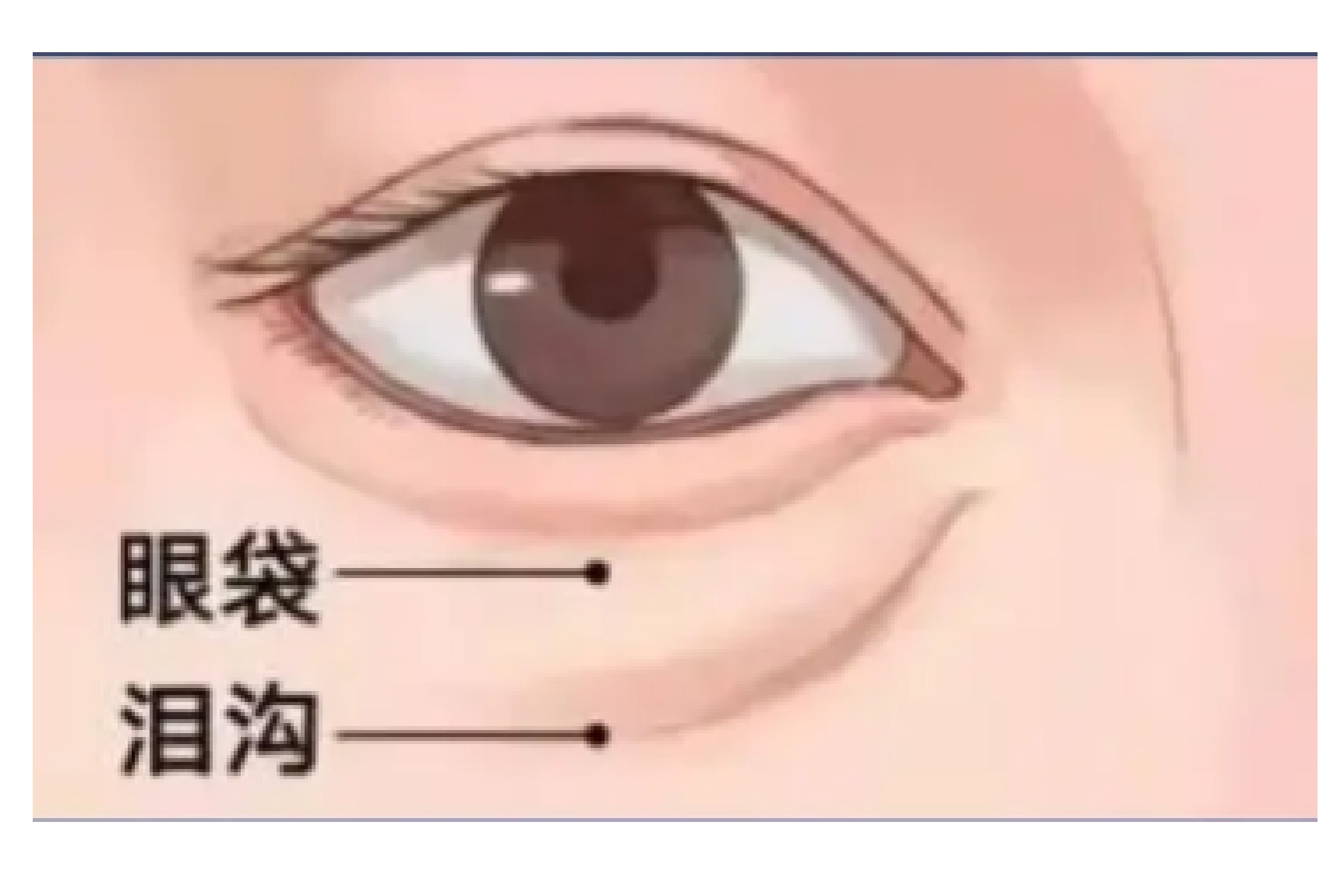 泪沟和眼袋图片