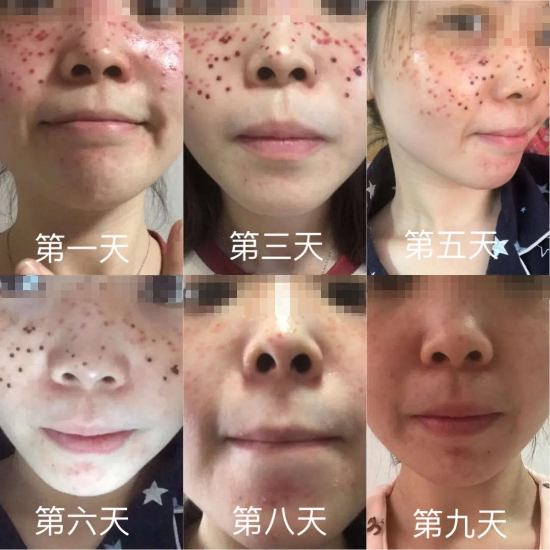 5天冷冻祛斑恢复过程图