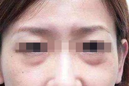 正常人眼袋图片
