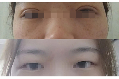 肿眼泡埋线双眼皮图片