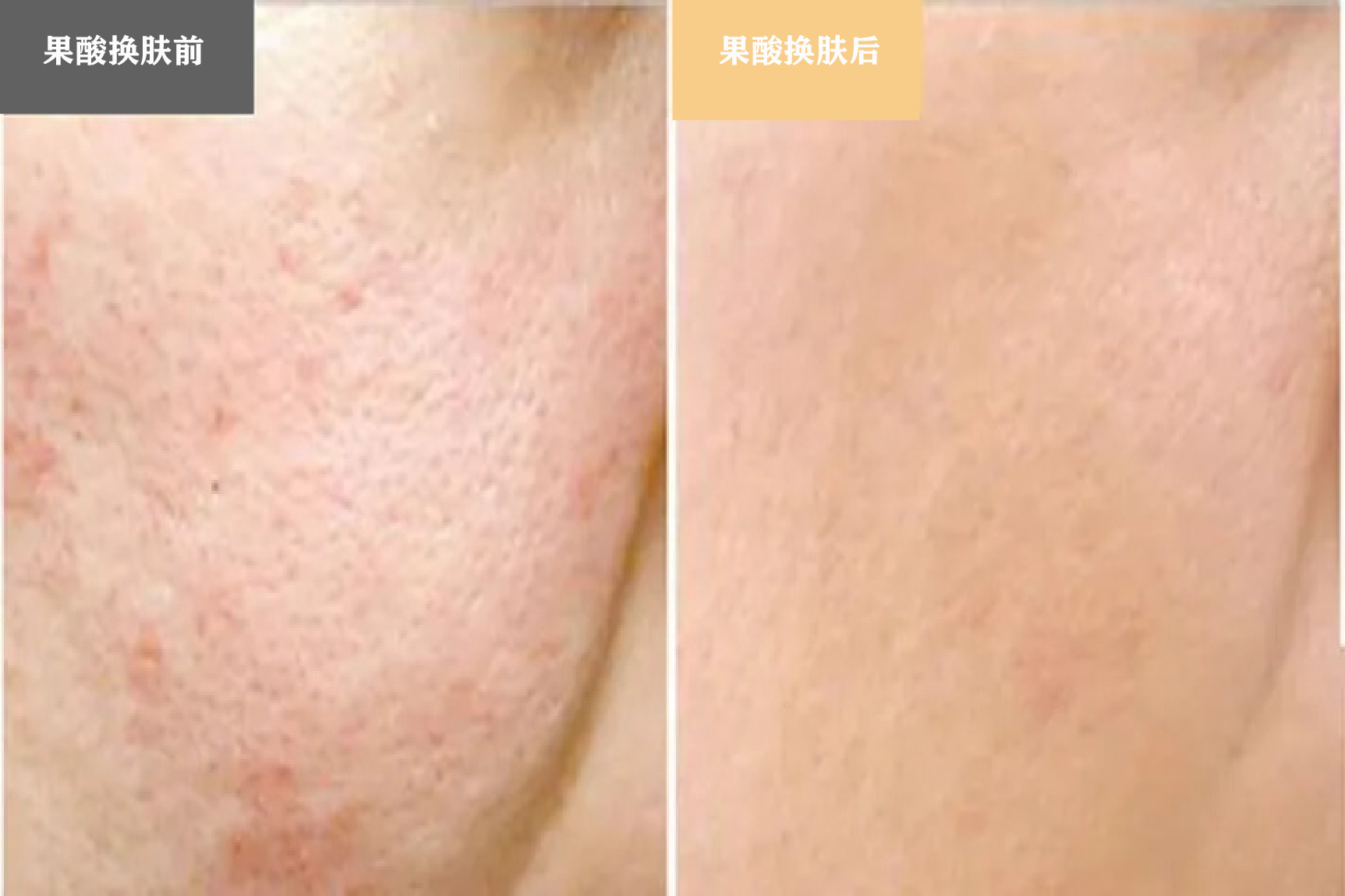 果酸换肤前后图