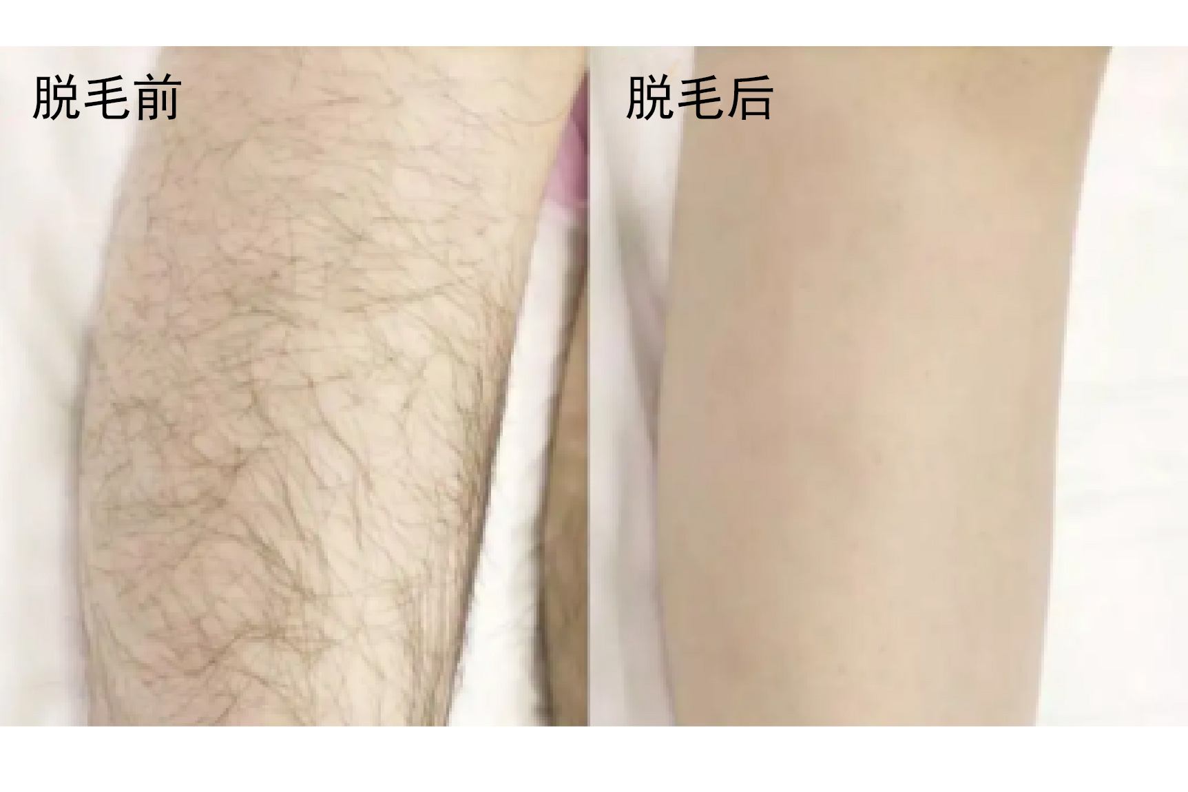 脱毛效果图