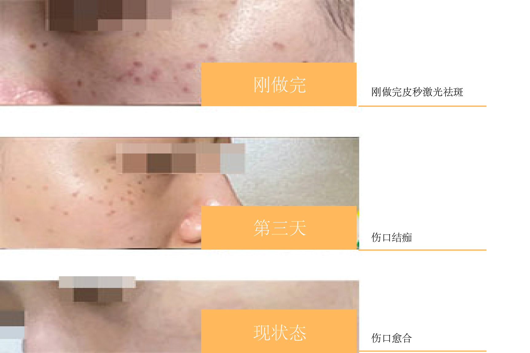 皮秒激光祛斑恢复过程图