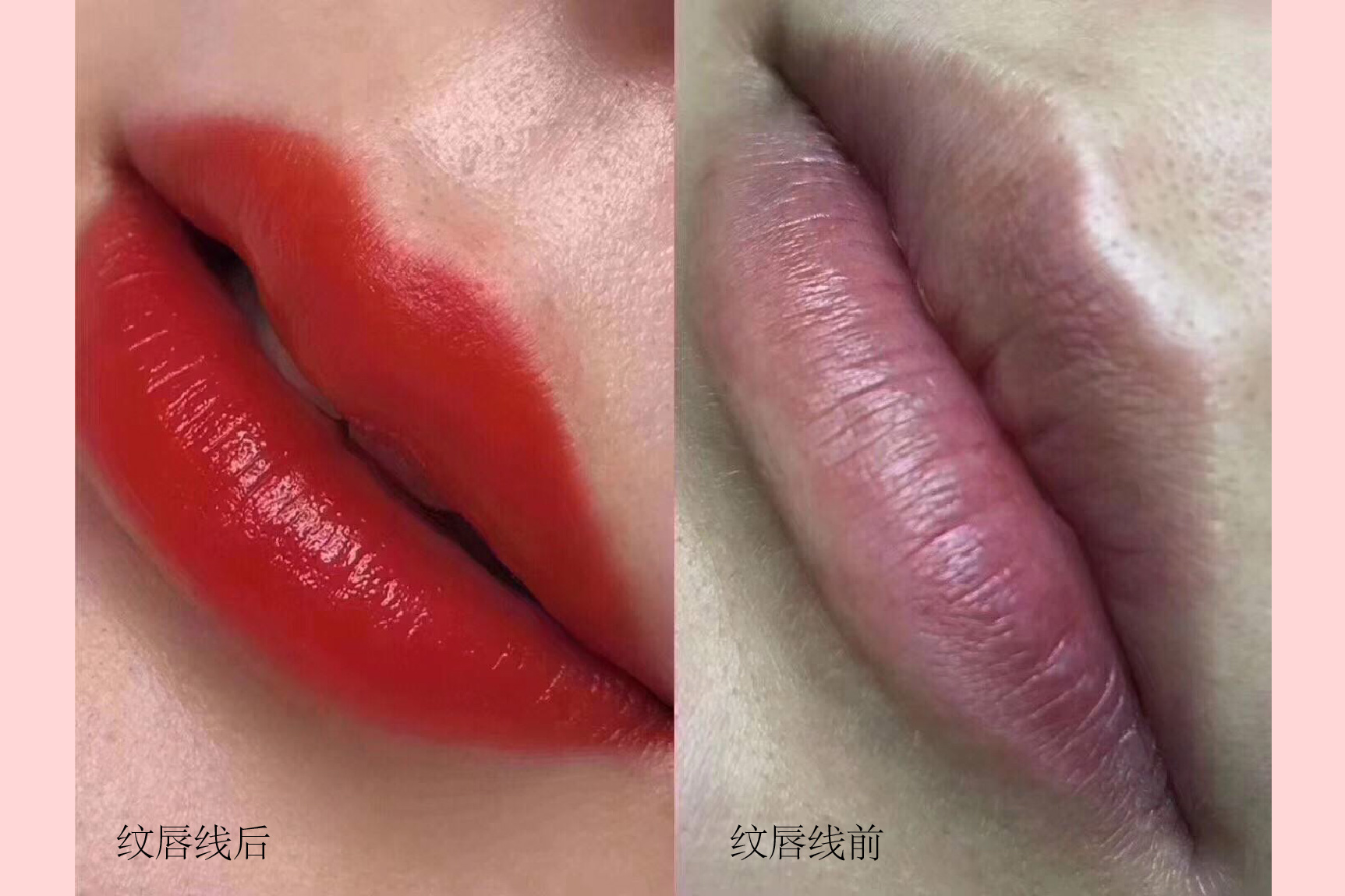 纹唇线前后对比图