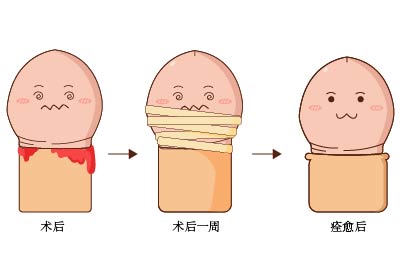 成年男性割包皮后的照片