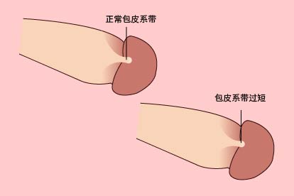 包皮系带过短的图片