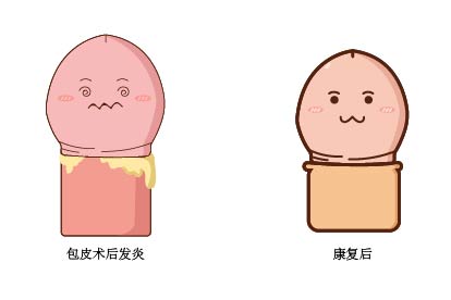 包皮术后发炎照片