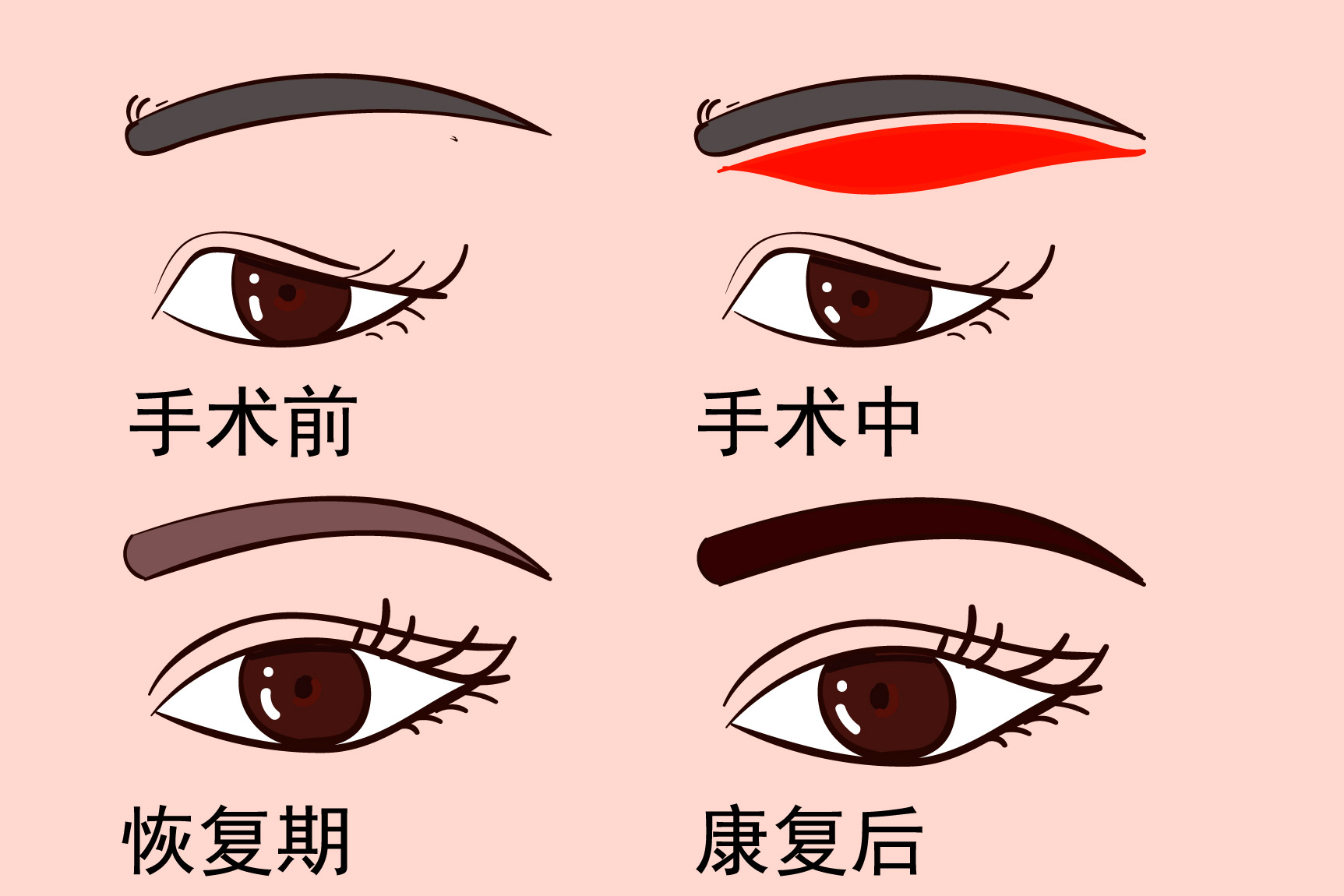做提眉手术恢复过程图
