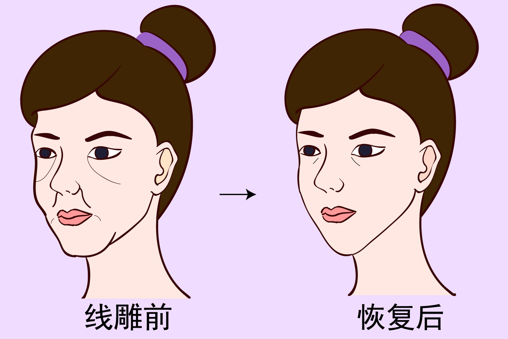 线雕前后对比效果图