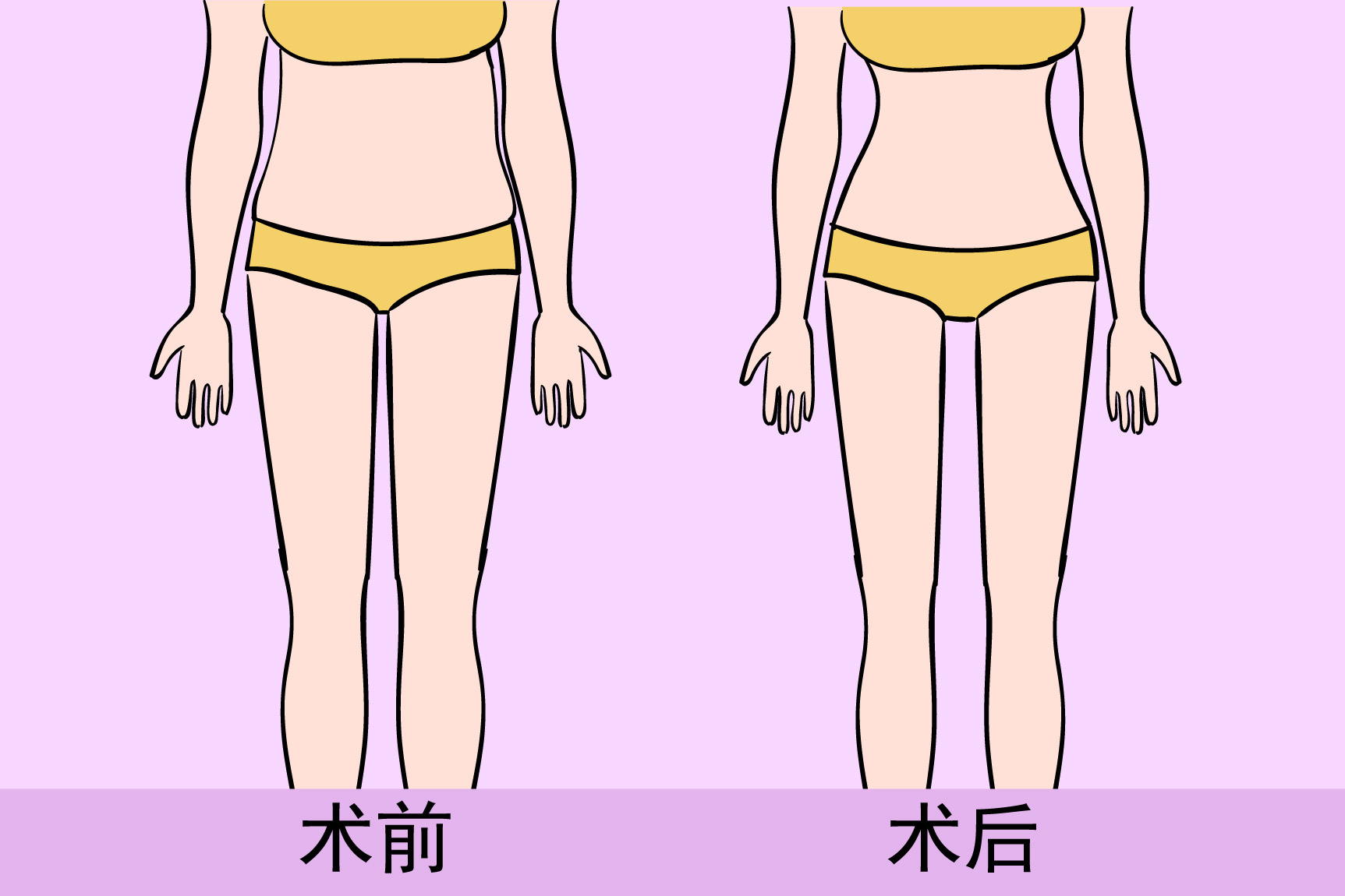 大腿吸脂后的真实图片