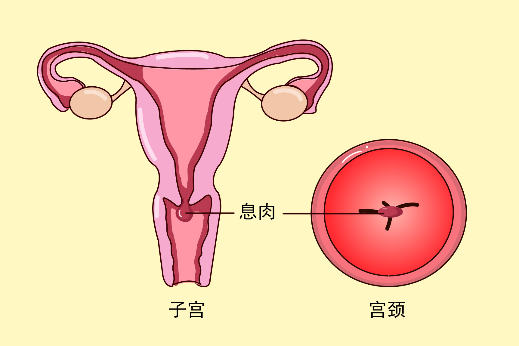 宫颈息肉图片