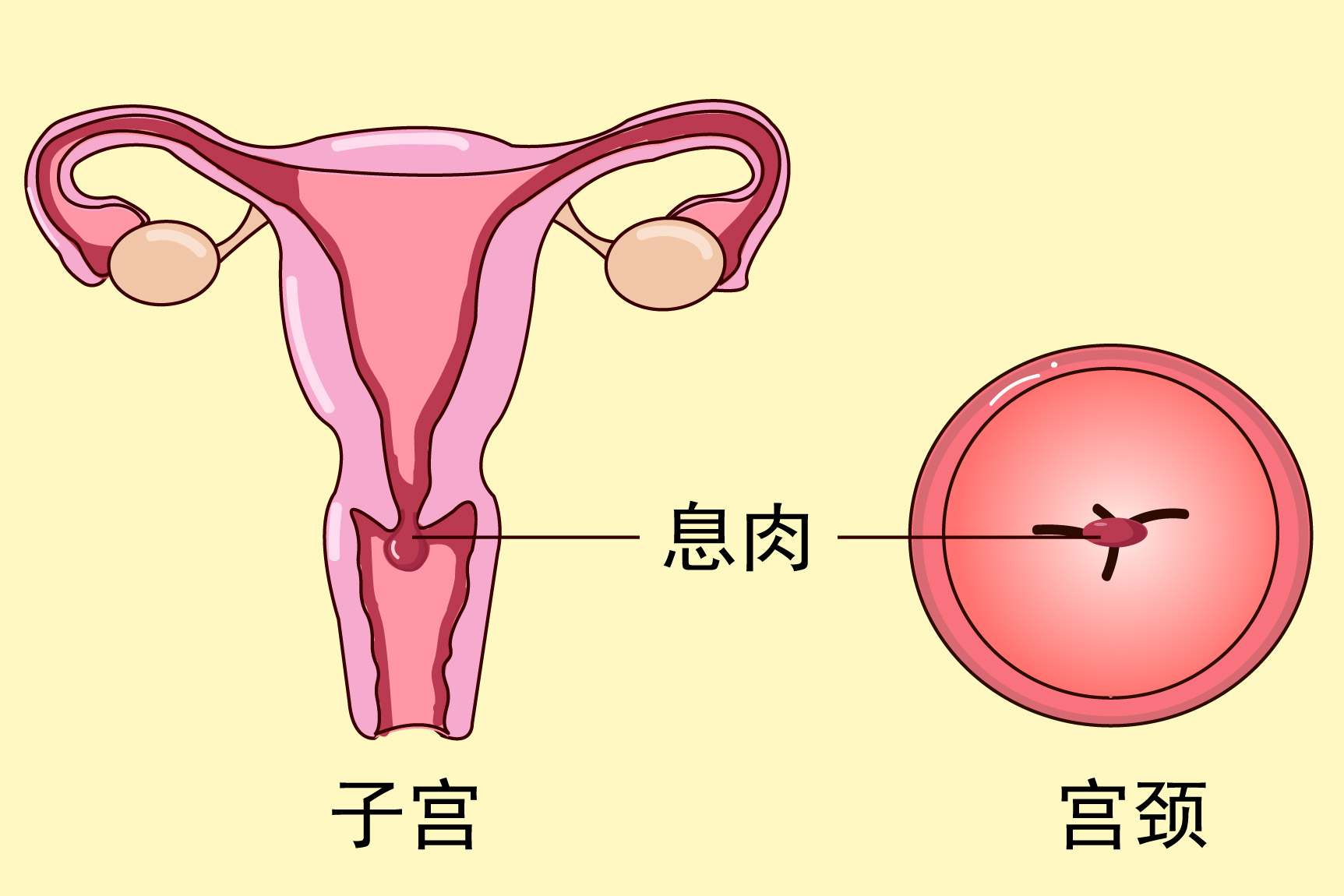 宫颈息肉图片