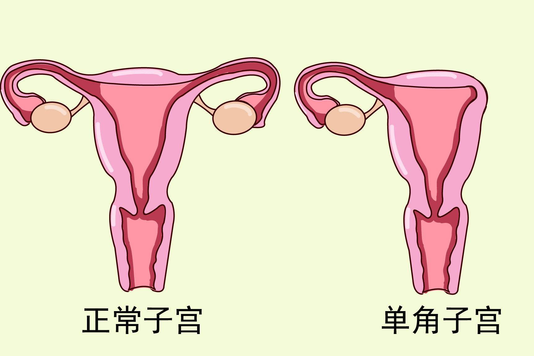 单角子宫图片