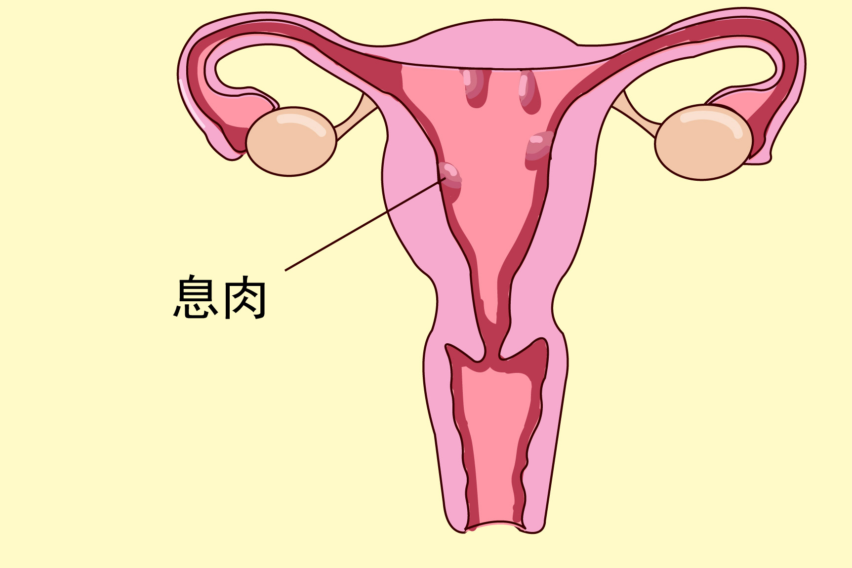 子宫内膜息肉图