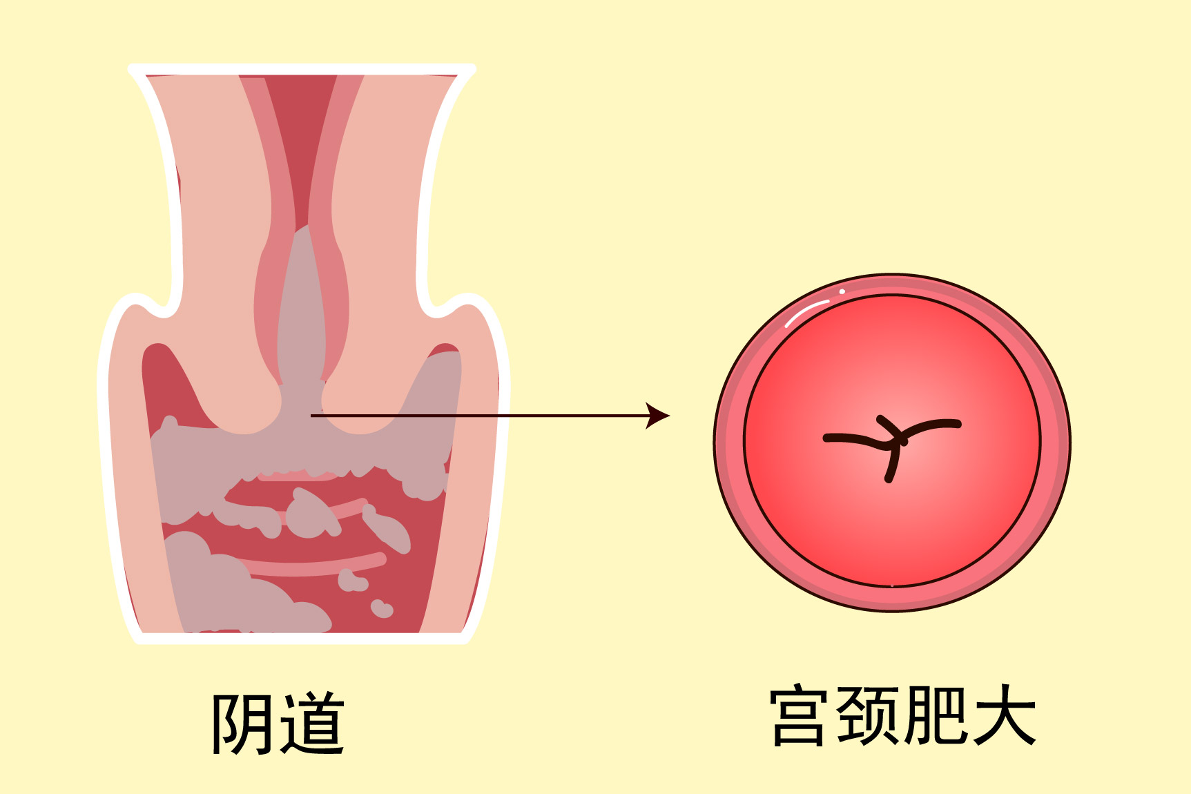 宫颈炎图片