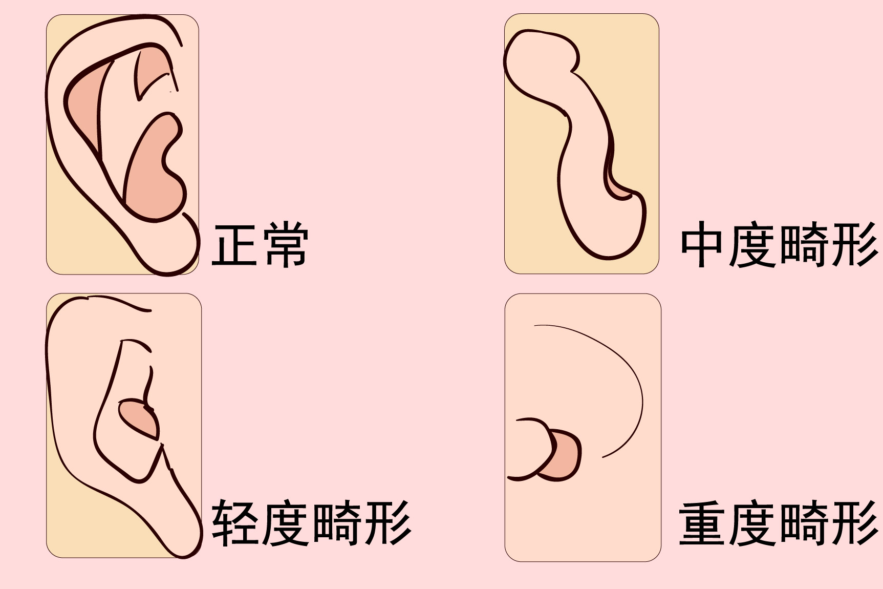 外耳道畸形图片