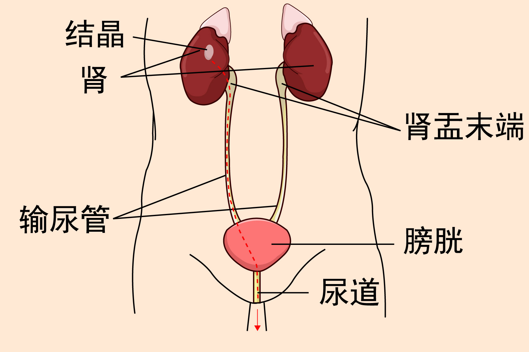 尿结晶排出体外的图片