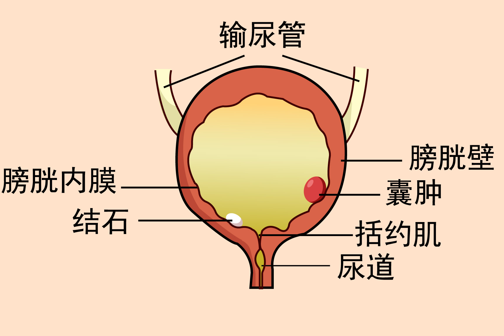 膀胱处有硬块图片