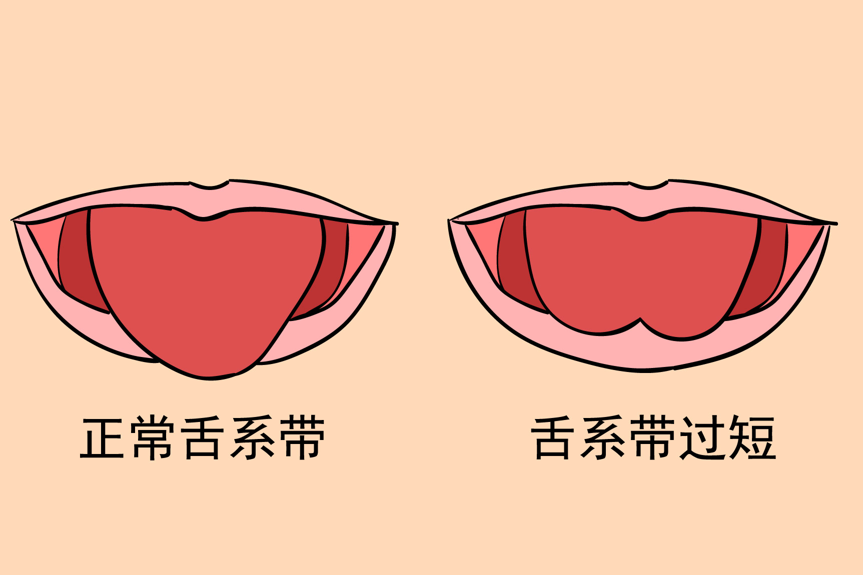 舌筋短图片