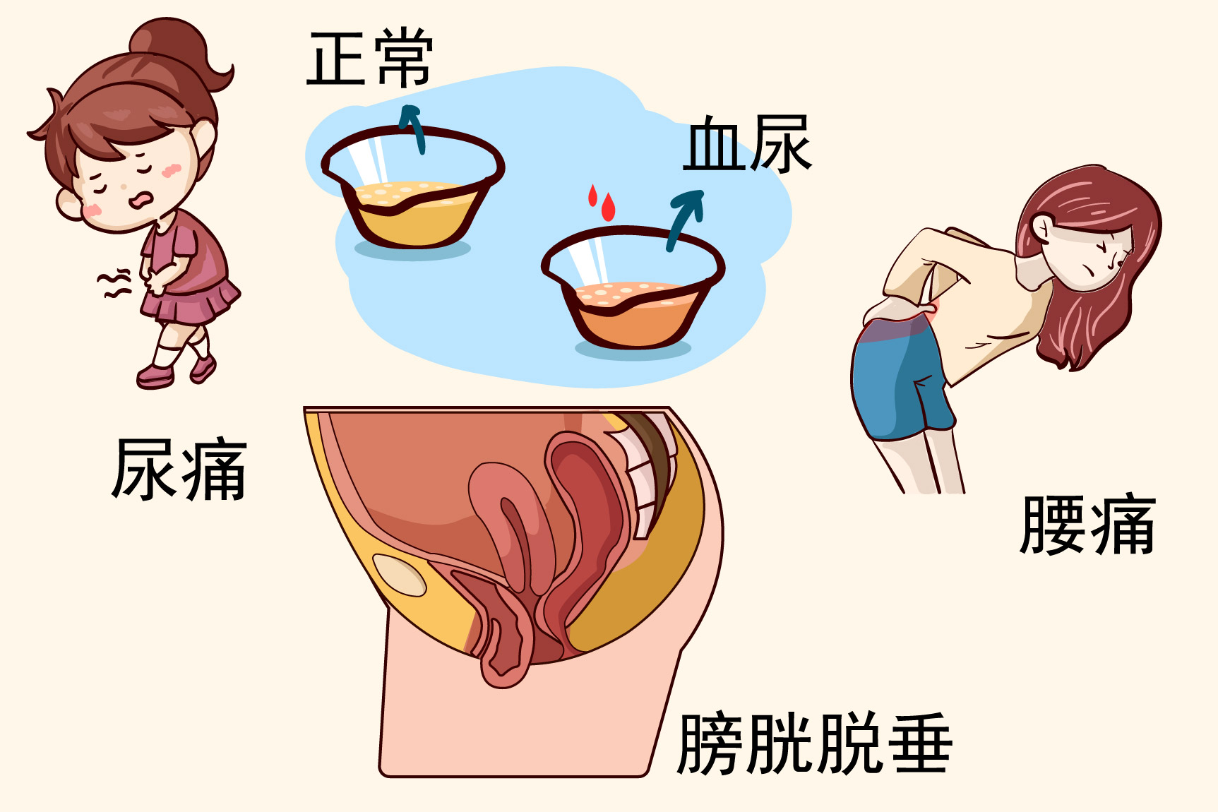 尿道脱垂症状图片
