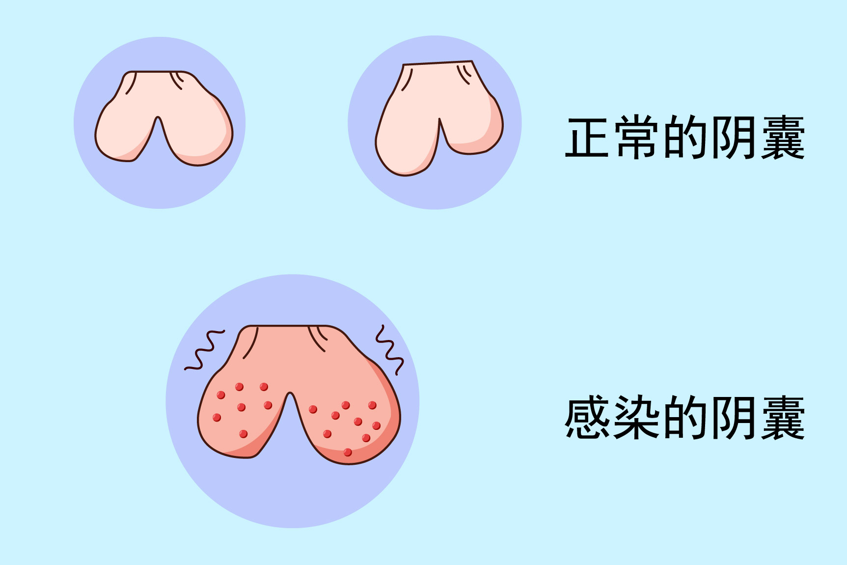 细菌阴囊溃烂图片