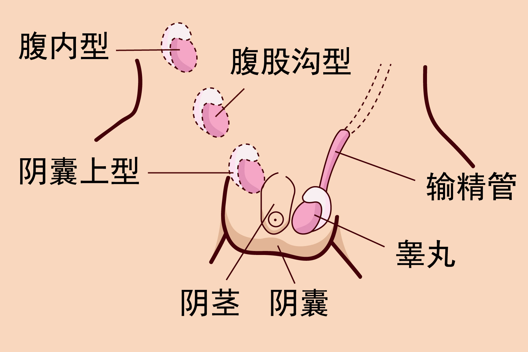 左侧隐睾腹股沟图