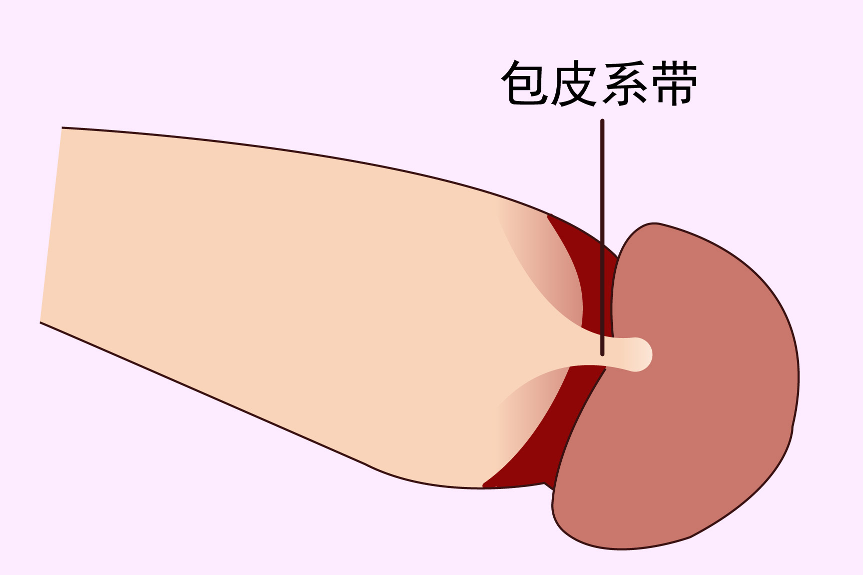 包皮系带有瘀血图