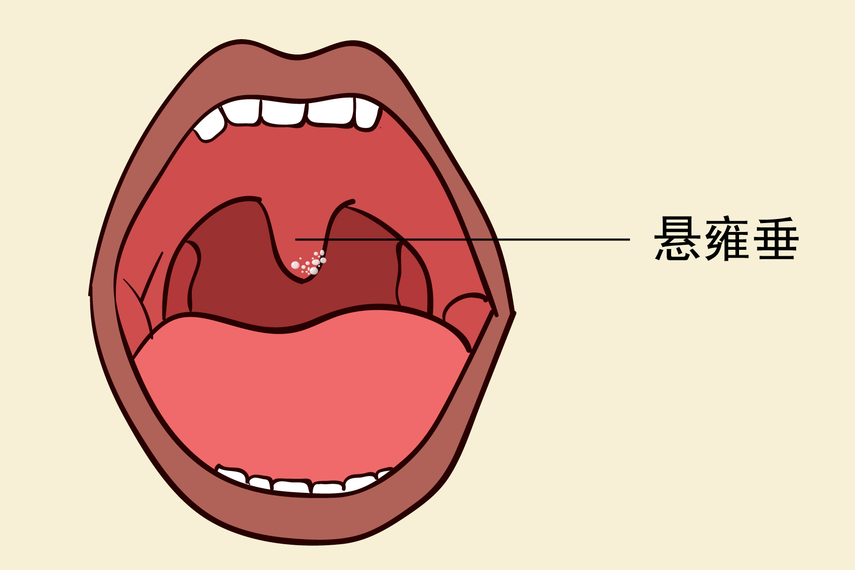 悬雍垂透明水泡图