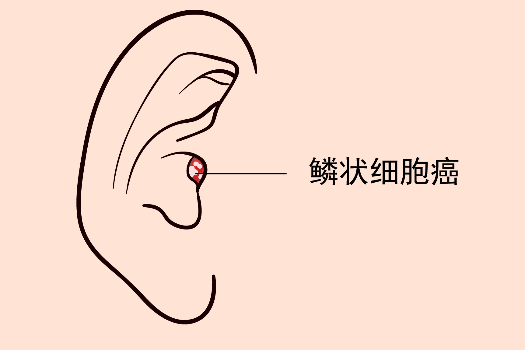 耳道鳞状细胞癌图