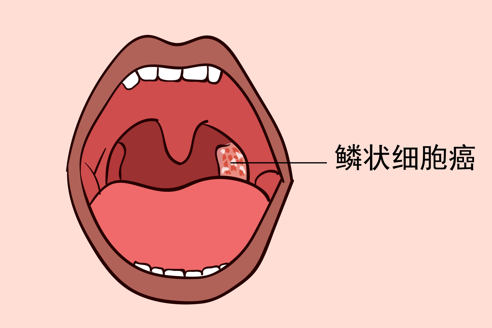 扁桃体细胞癌图