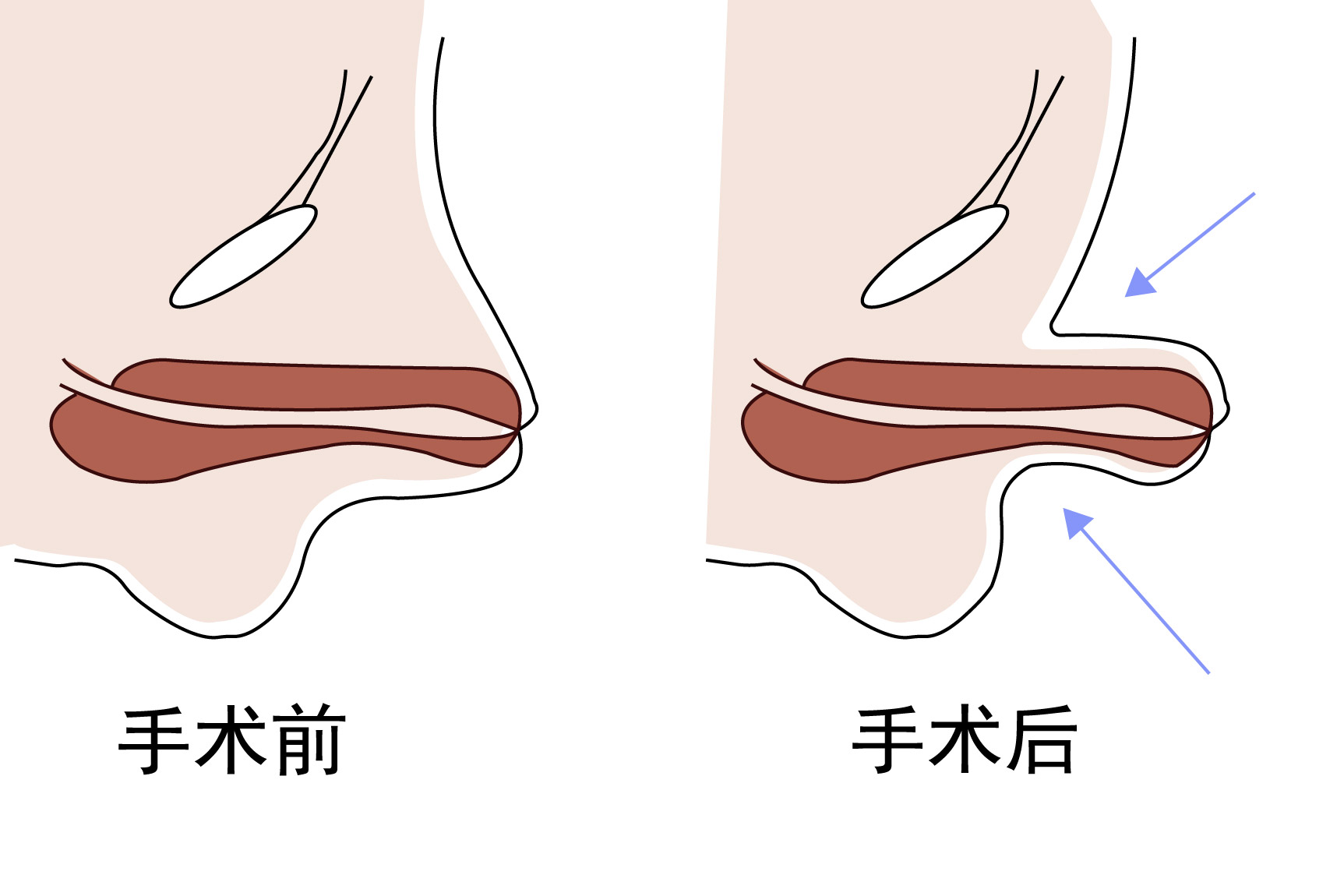 隐匿性阴茎术后图