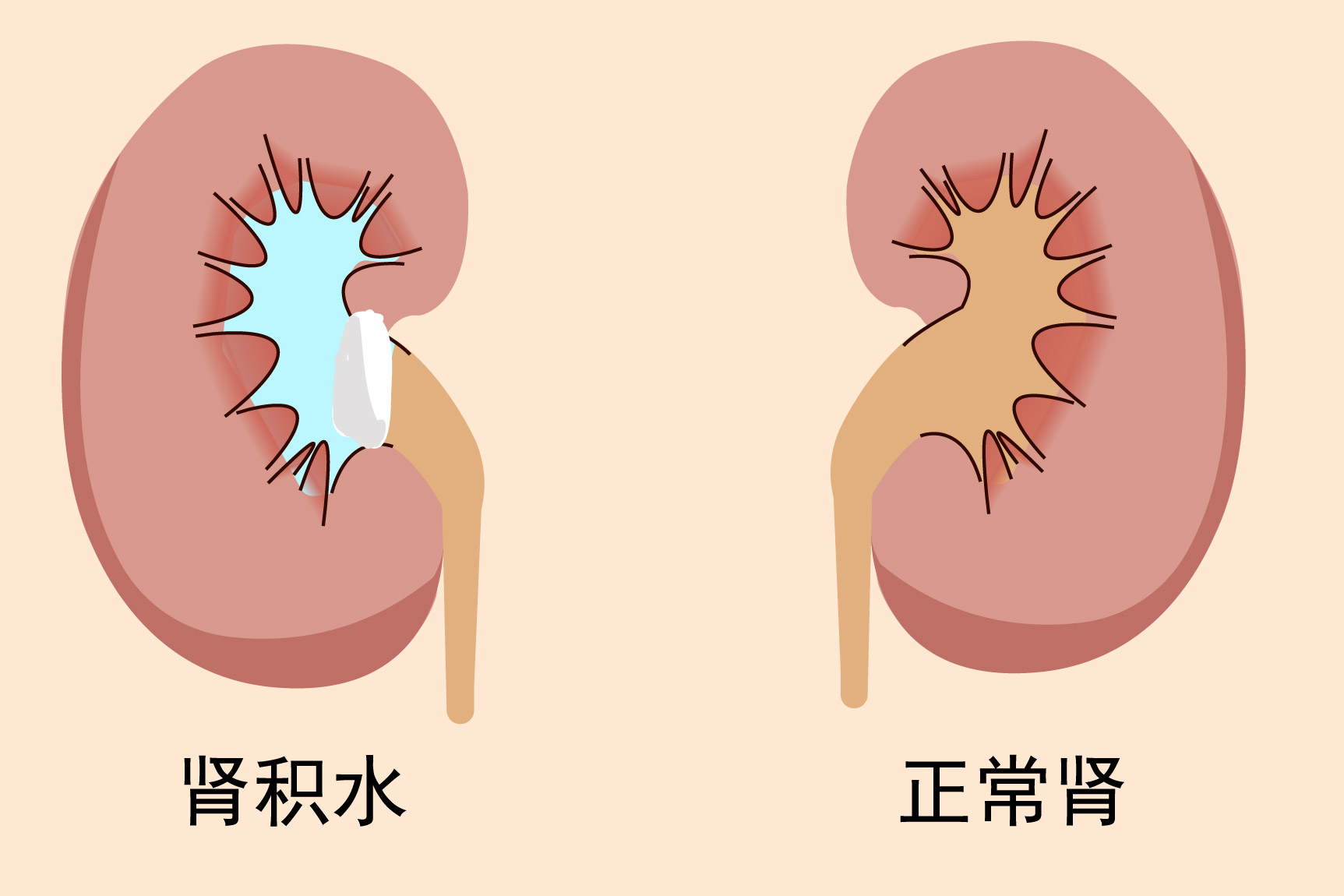 右肾积水图片