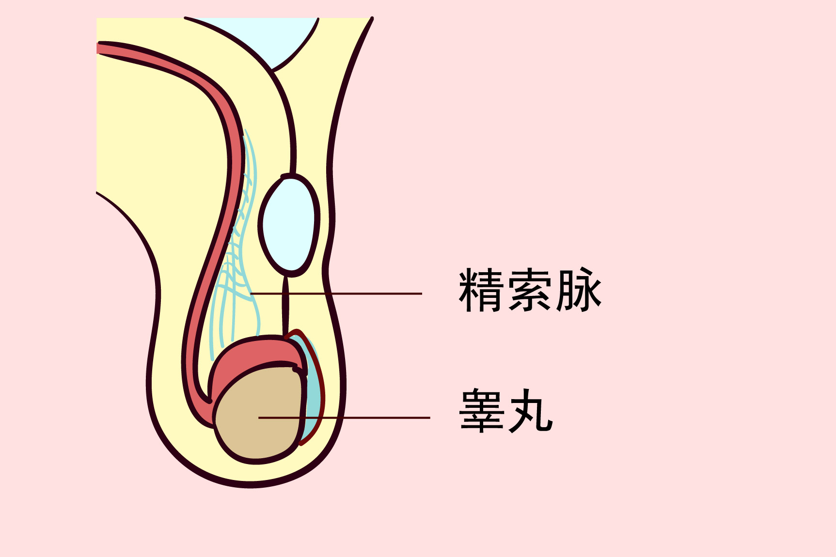 精索鞘膜积液图片