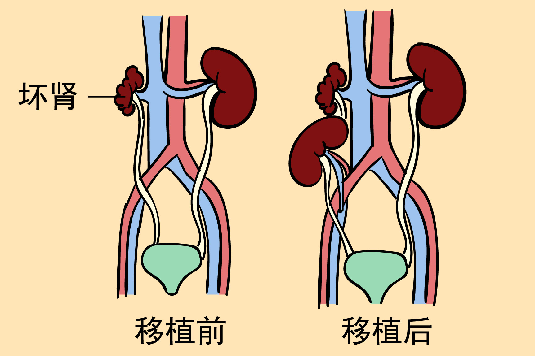 肾移植图片