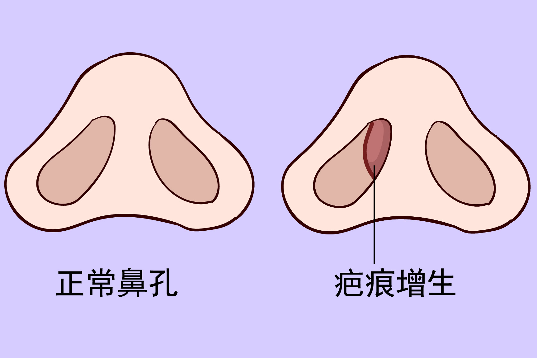 隆鼻后鼻孔内壁有凸起硬物图