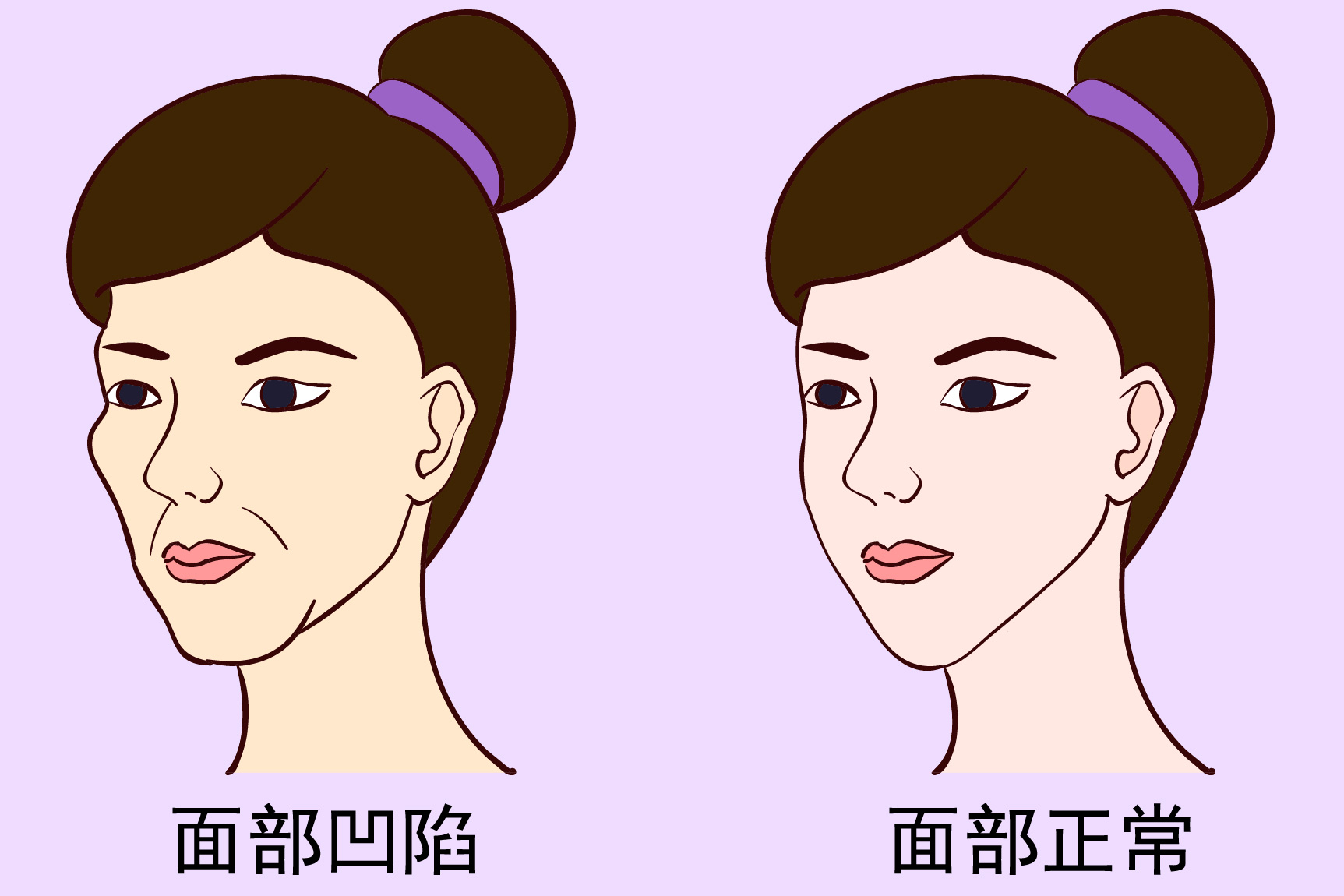 面部凹陷对比图片