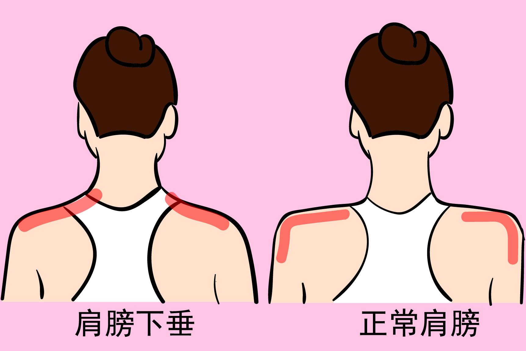 肩膀下垂图片