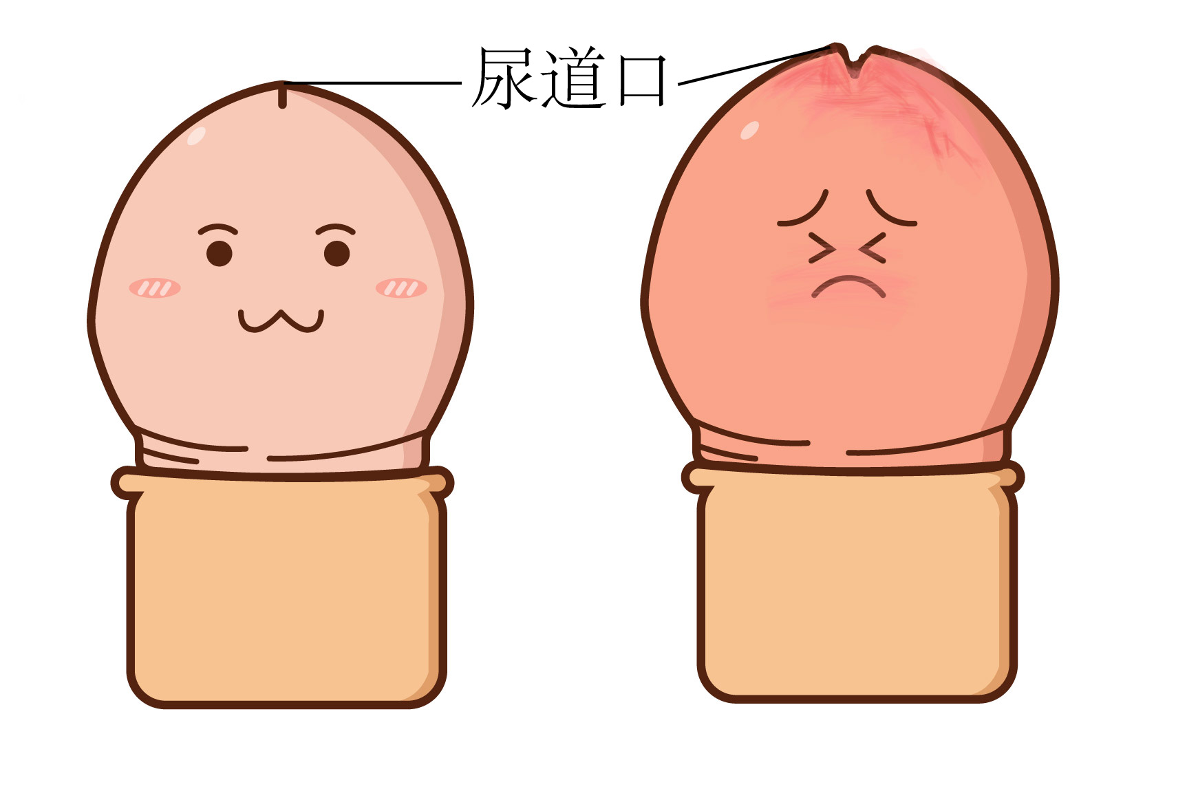 尿道口外翻图片