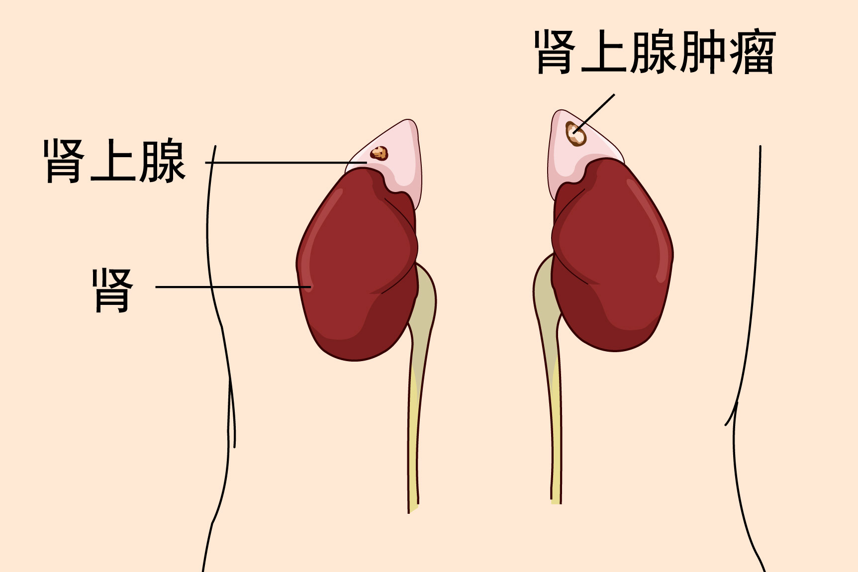 肾上腺肿瘤图片