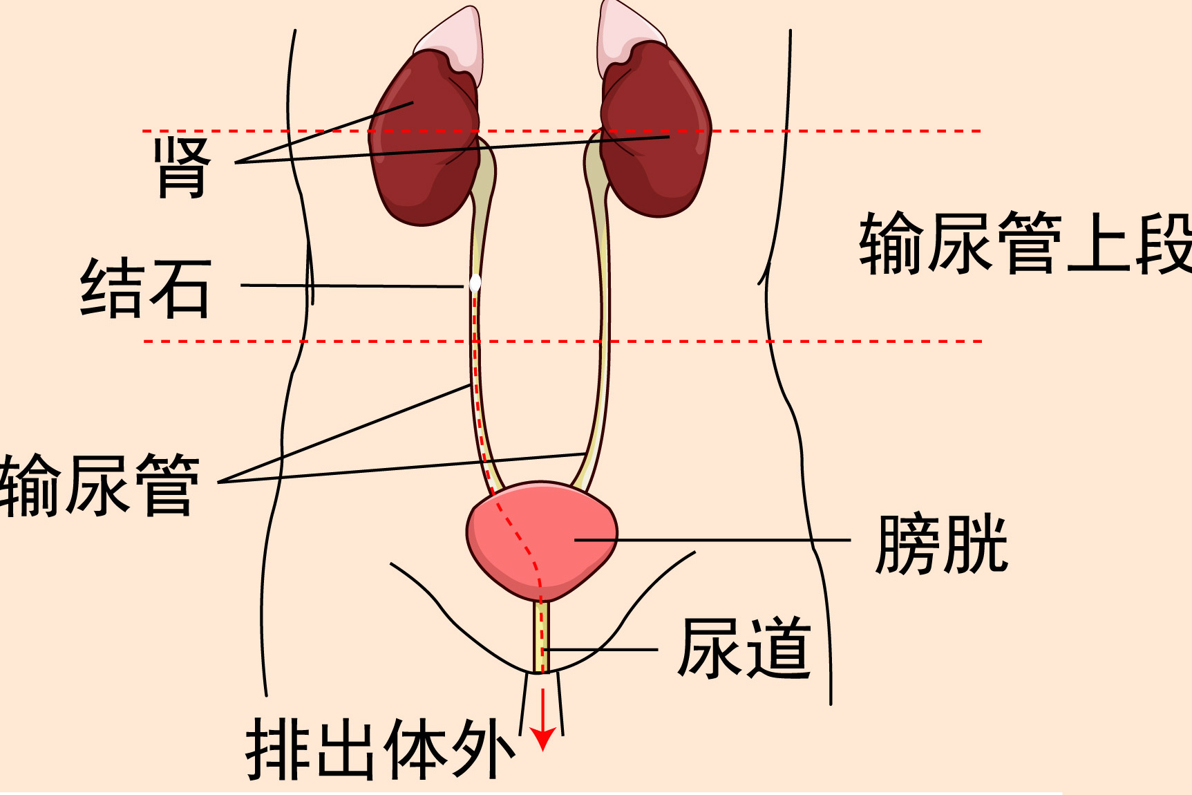 输尿管上段结石图