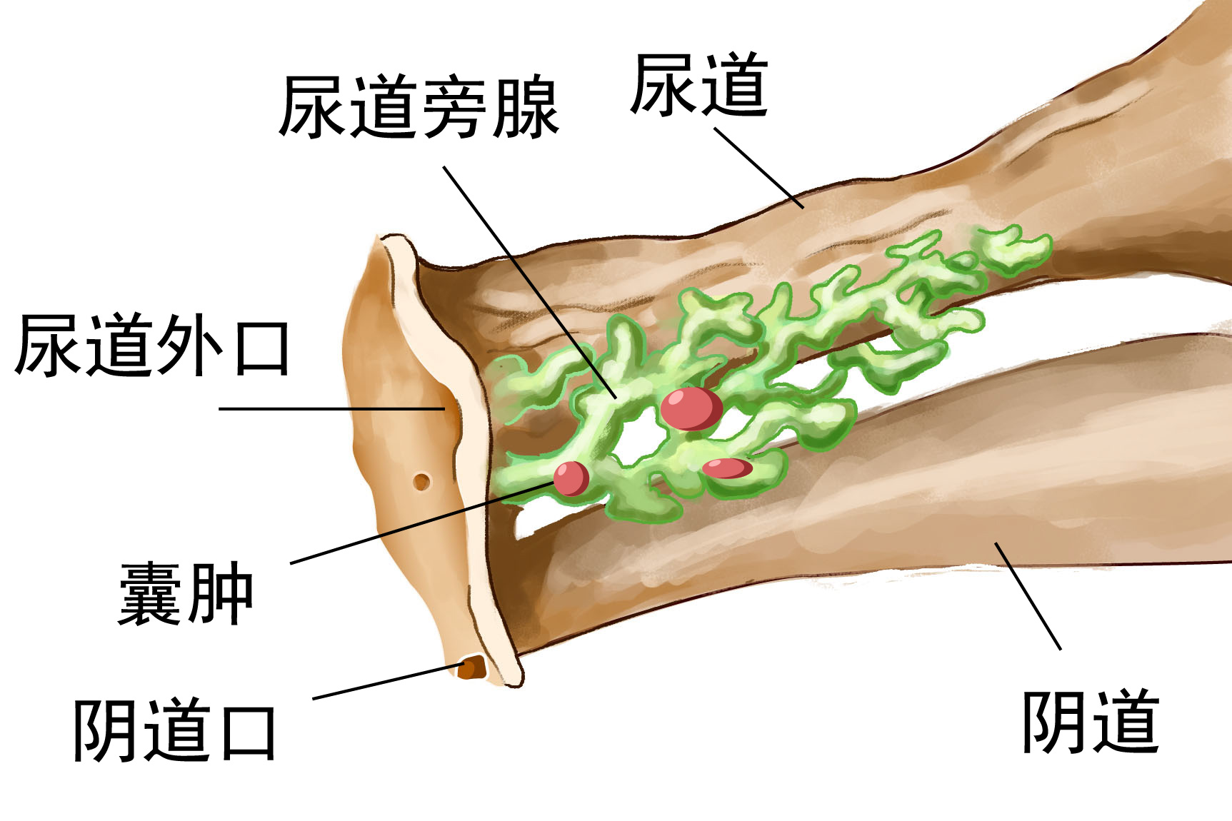 尿道旁腺囊肿图