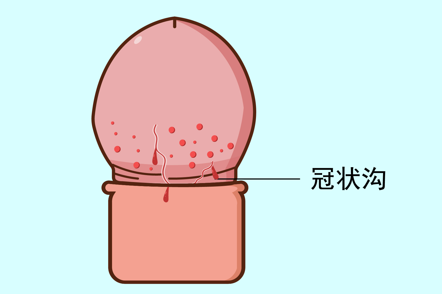 冠状沟开裂症状图
