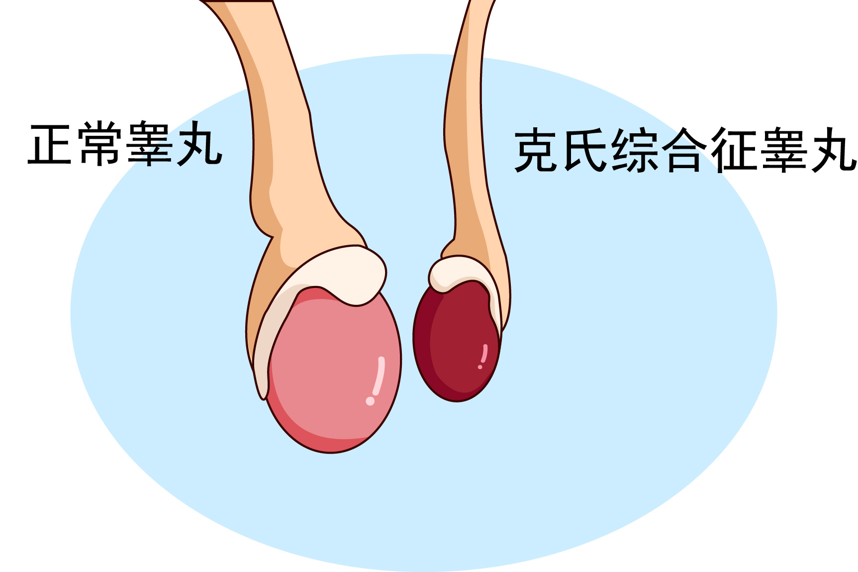 克氏综合征睾丸图